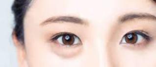 眼袋和卧蚕有什么区别？怎样去除显老的眼袋？这篇文章给你答案