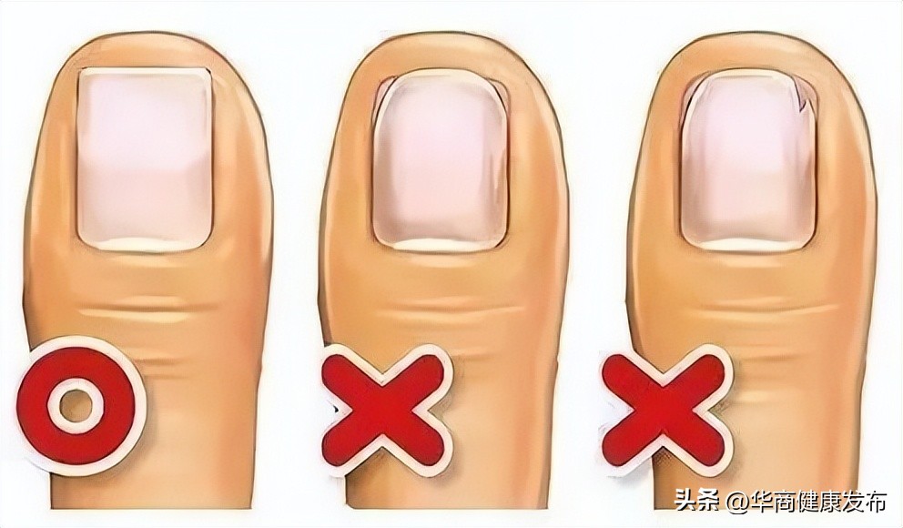 甲沟炎皮肤护理,为什么那么容易得甲沟炎