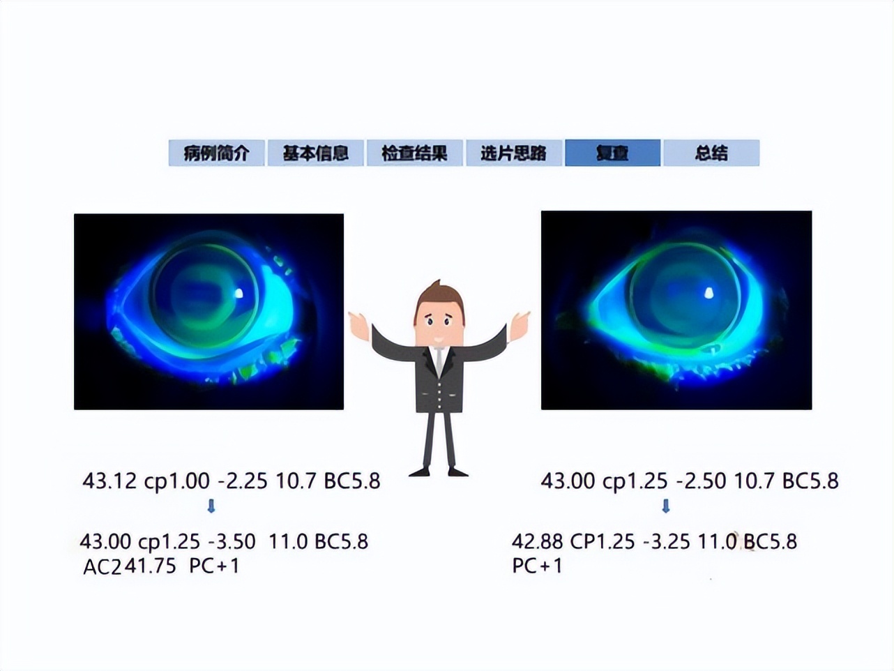 王凯角膜塑形镜原理,王凯医生塑形镜