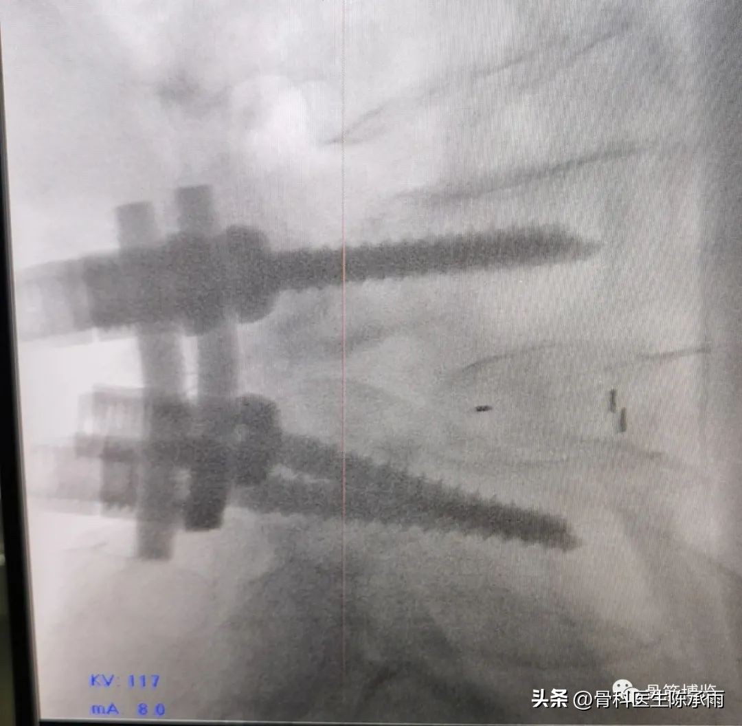 腰椎滑脱椎管狭窄手术后遗症,腰椎间盘突出椎管狭窄的手术