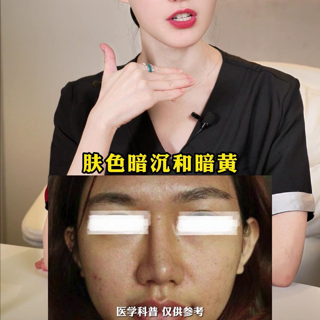 一条视频告诉你，祛痘印怎么选！#痘坑