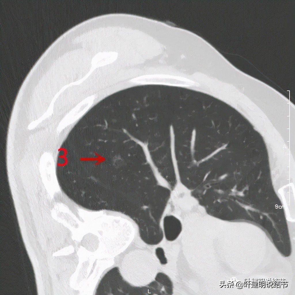 肺多发结节切除一个剩下的怎么办,无限纠结的肺小结节