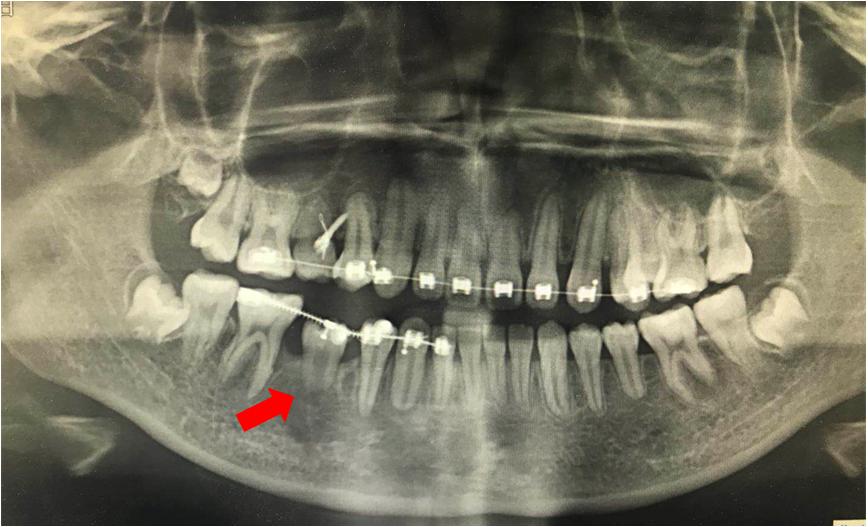 牙齿长小牙该怎么拔掉,牙齿长在上颌窦里了能拔吗