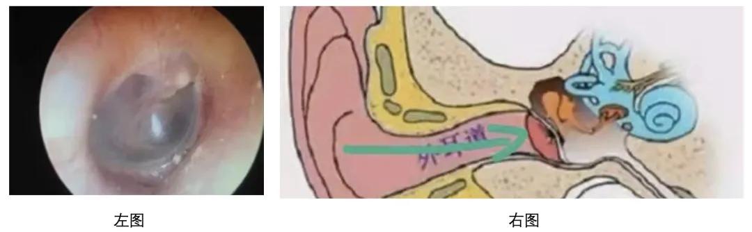 儿童中耳炎是怎么导致的耳朵疼,小孩中耳炎如何缓解耳朵疼痛