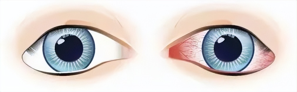 眼睛痒越揉越痒是过敏性结膜炎吗,换季眼干眼痒小心过敏性结膜炎