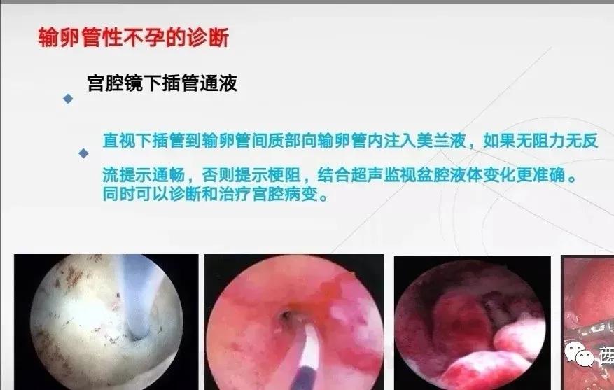 比输卵管造影好的输卵管检查,输卵管检查需要多少费用