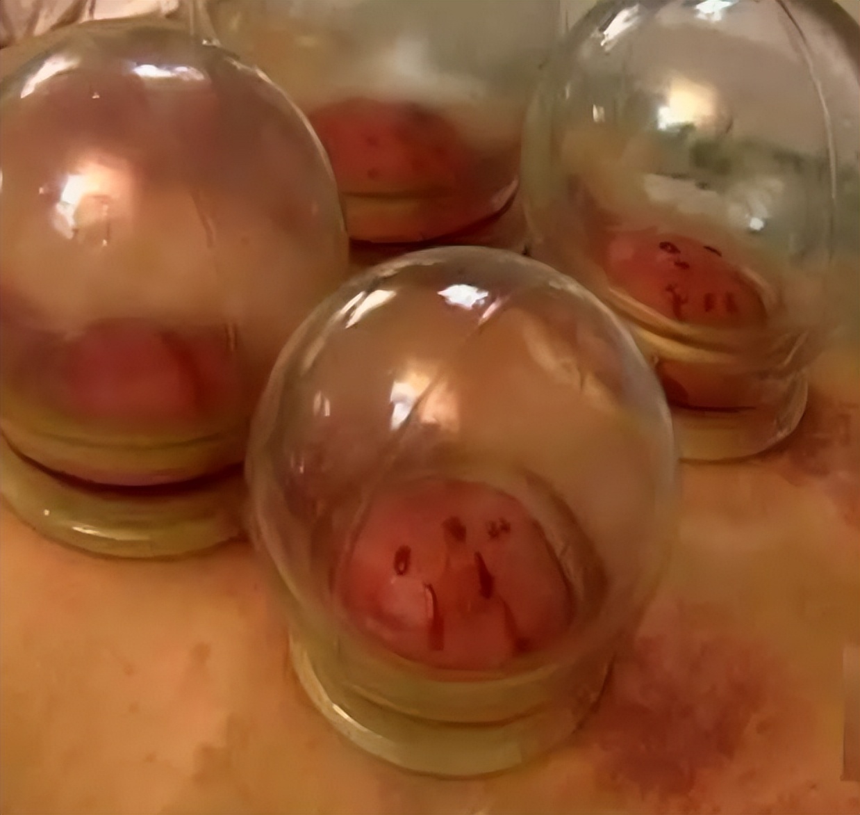 刺络拔罐治什么病,刺络拔罐全过程