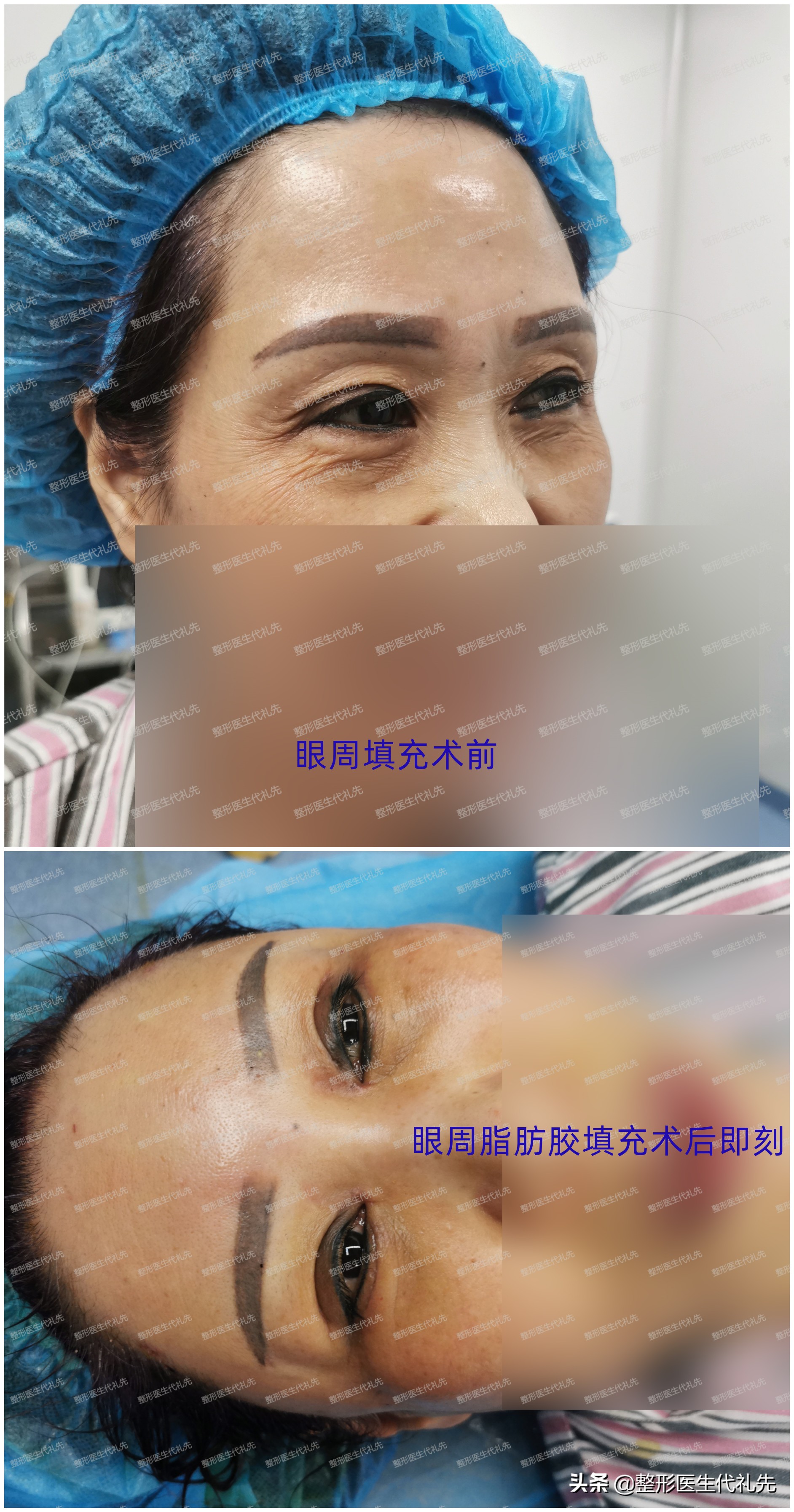 眼下细纹除皱教程,眼下细纹怎么去除做手术