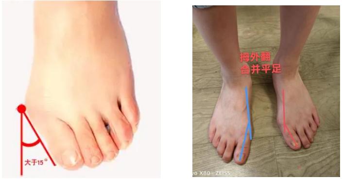 儿童拇外翻如何干预,儿童拇外翻可以治疗吗