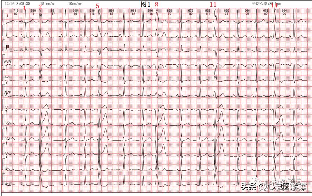 窦性心律偶见室性融合波,室性并行性心律