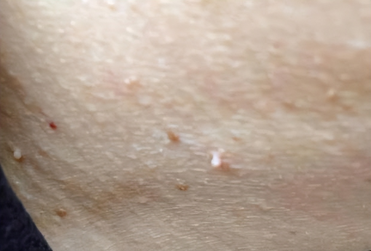 脖子上肉粒可以自己揪掉么,脖子腋下长小肉粒可以用手揪掉吗