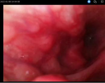 鱼刺卡喉求医6次,记录求医之路