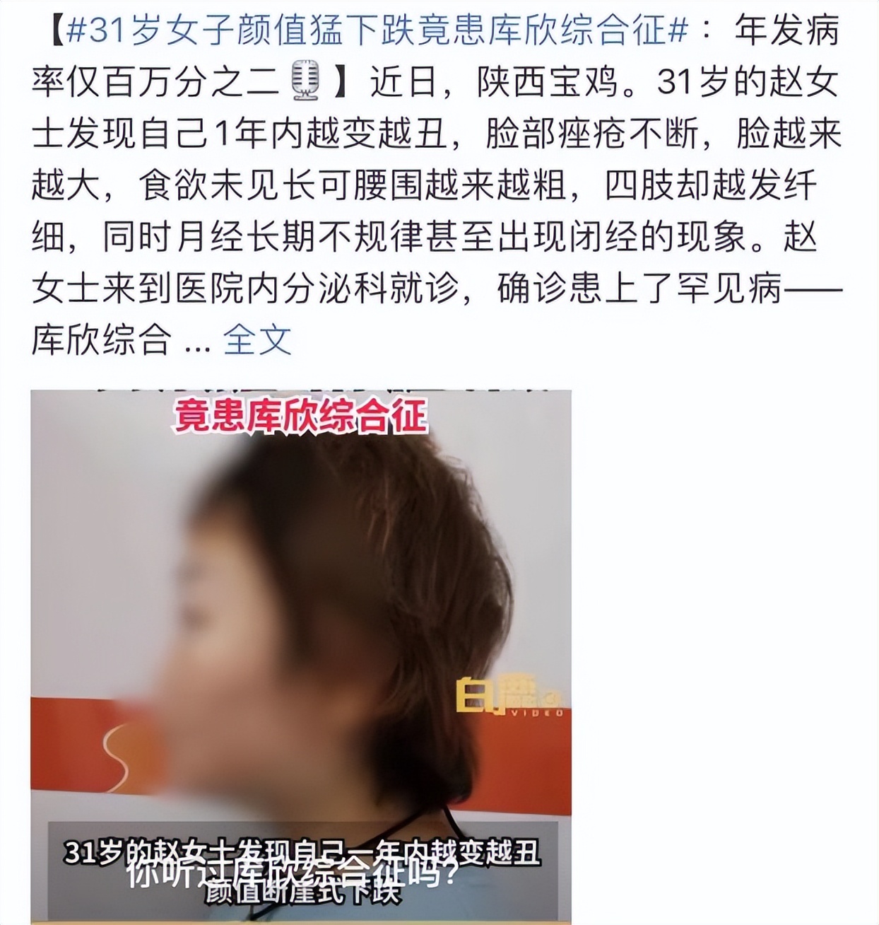 满月脸水牛背能恢复正常吗,满月脸水牛背怎么消除