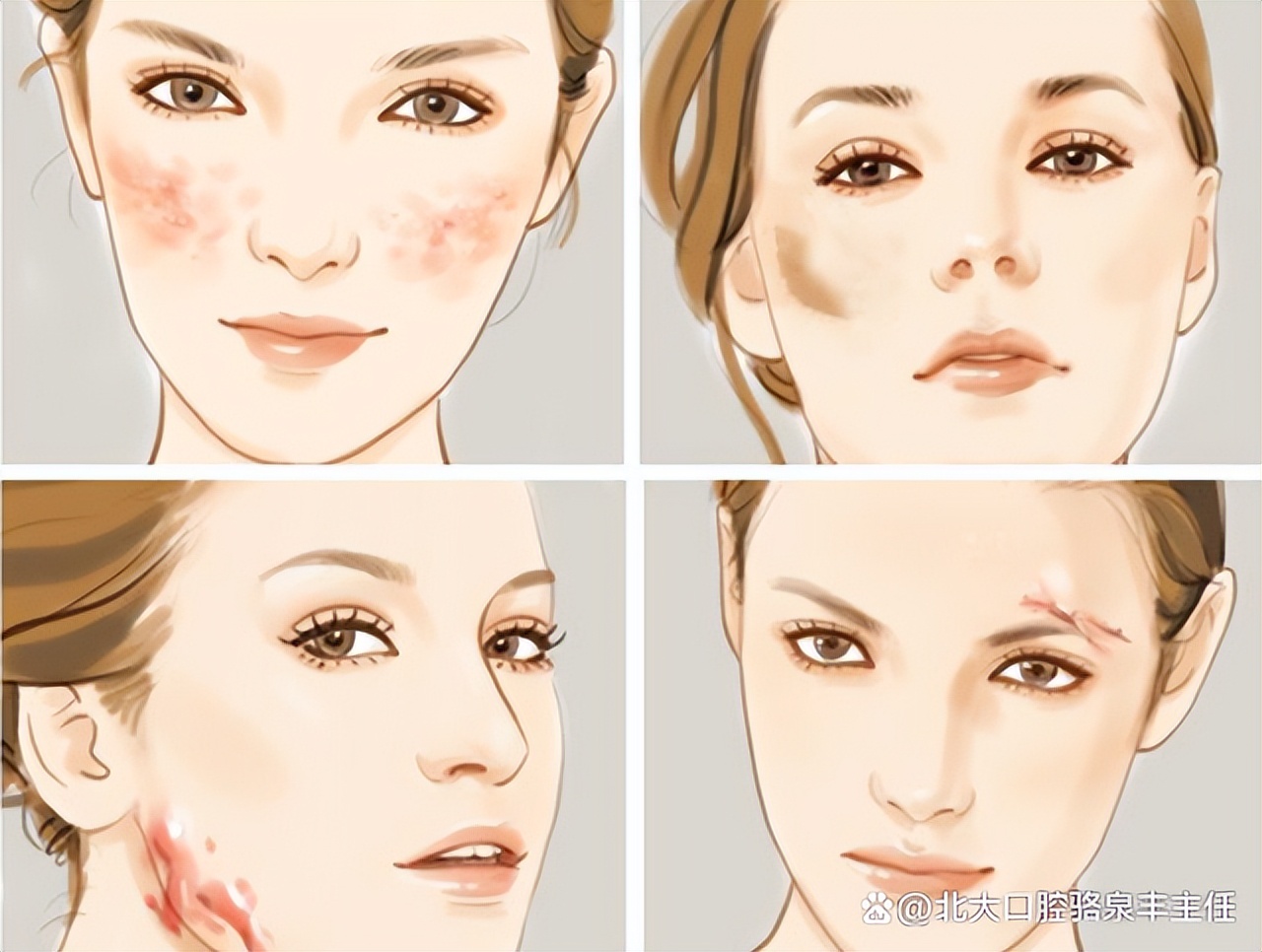 剖腹产疤痕增生发痒,增生疤痕周围发痒起痘