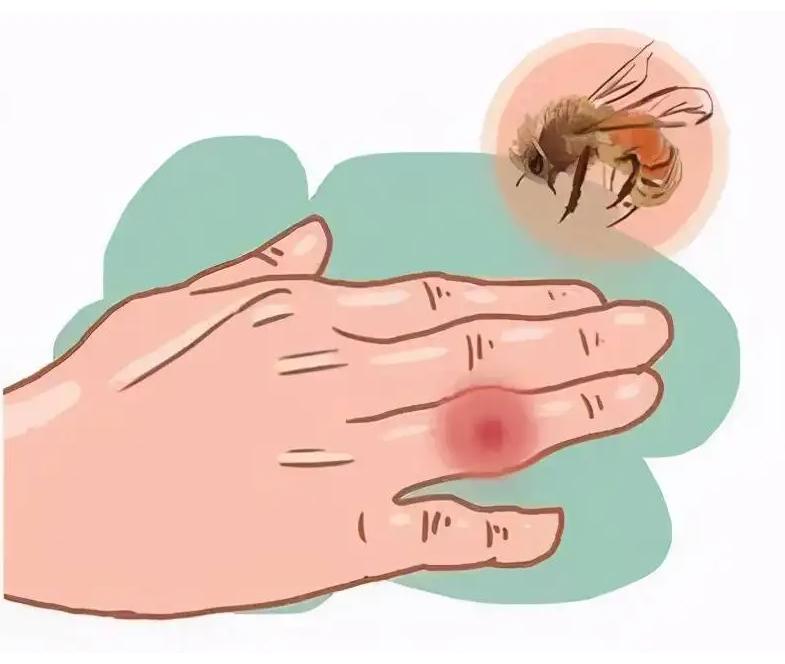 蜂蜇伤如何处理,蜂蜇伤最佳处理方法