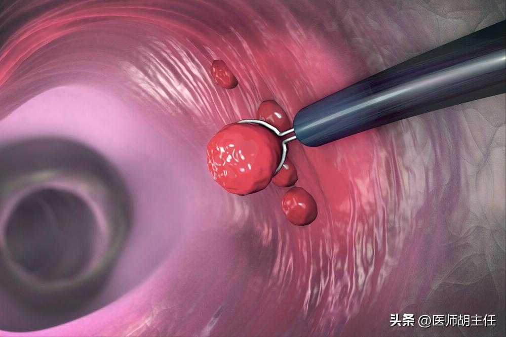 为什么肠道会长息肉,为什么肠道容易长息肉