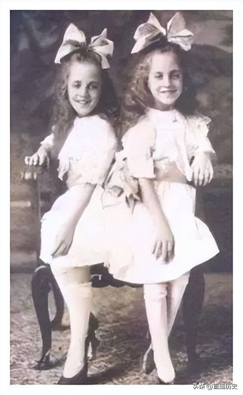 臀部连体姐妹：各有一名丈夫，姐姐死后，妹妹与遗体共存2天去世