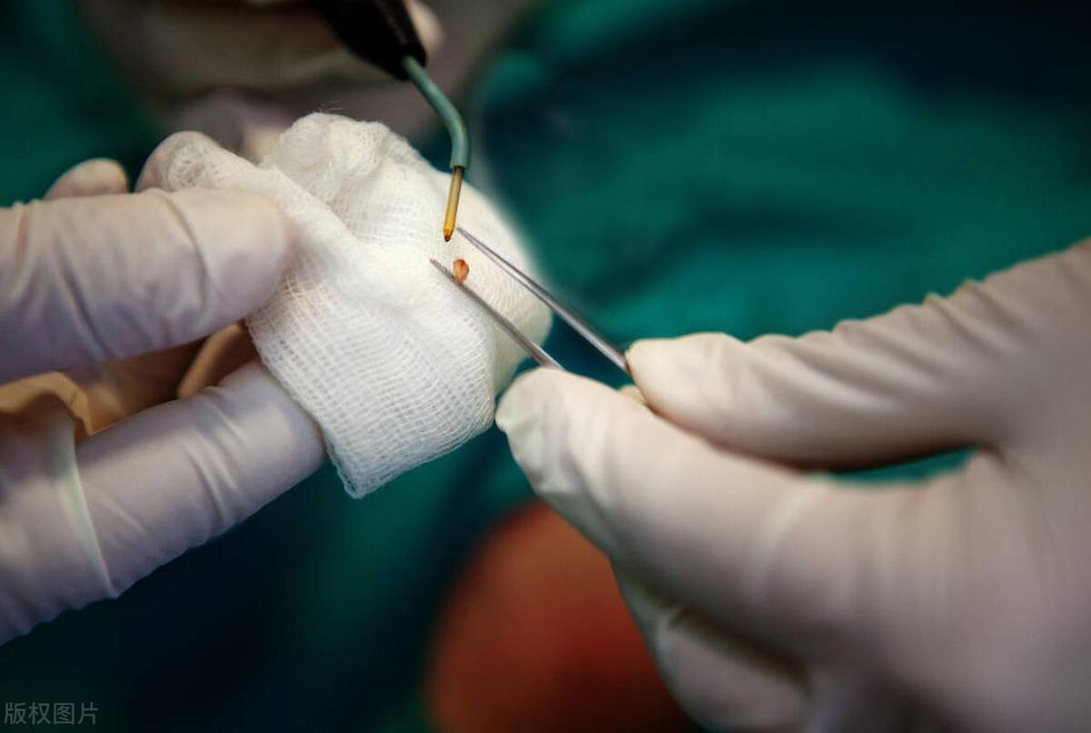 皮肤长的小肉球怎么自己处理,皮肤长出小肉球是什么原因