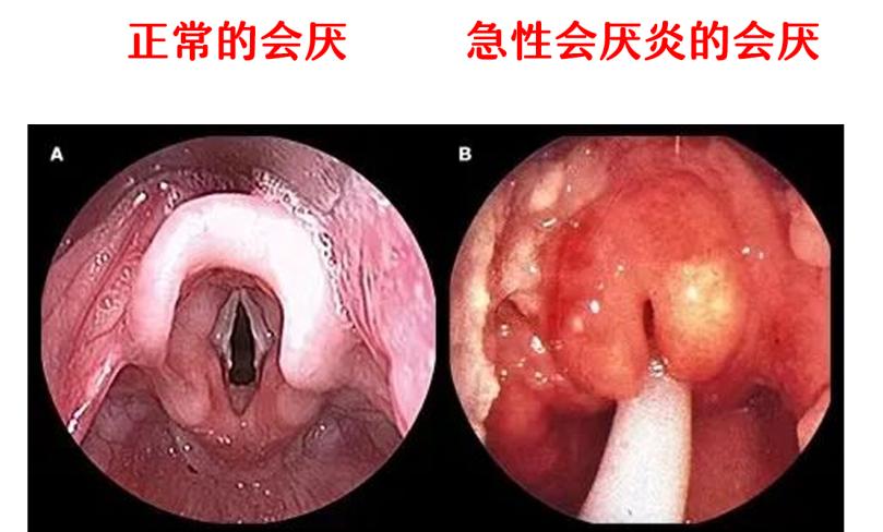 阳后喉咙痛会持续多久,半夜喉咙干疼要警惕四种疾病
