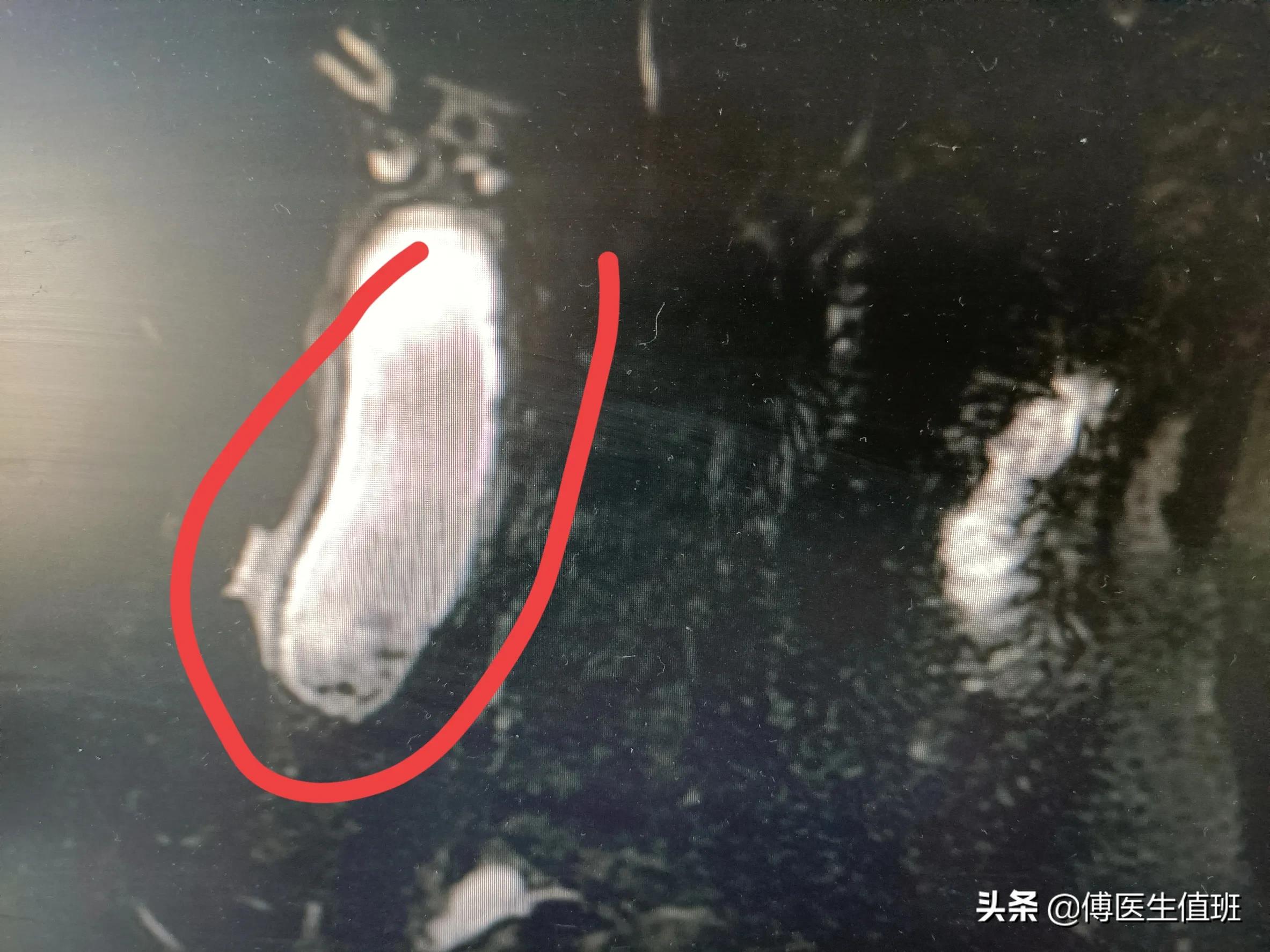 女子长期饭后腹胀,女子饭后常感腹胀误以为是胃病