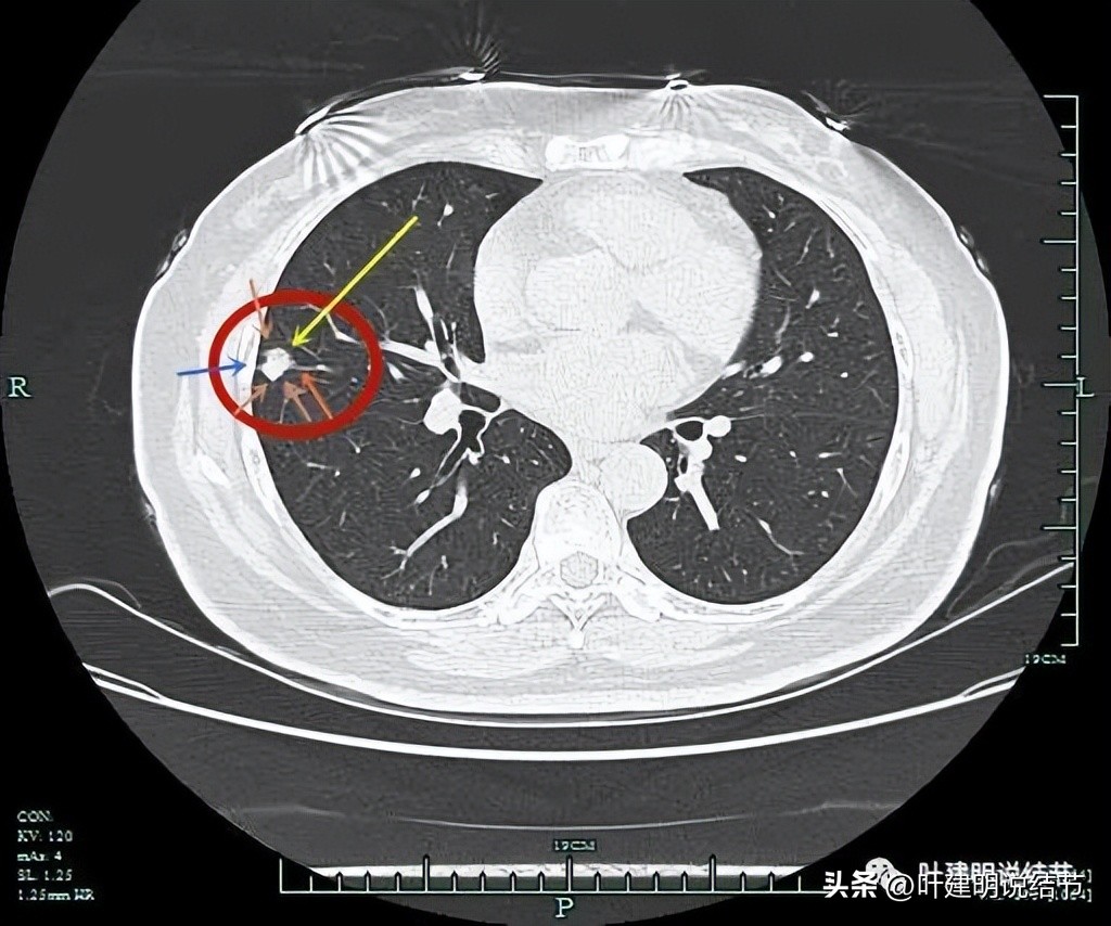 子宫内膜癌术后病灶大于二厘米,子宫内膜癌手术后一年又发现肺癌