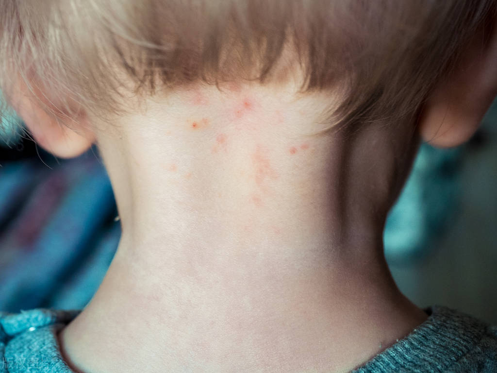 炉甘石怎么用止痒效果最好,炉甘石都有哪些剂型