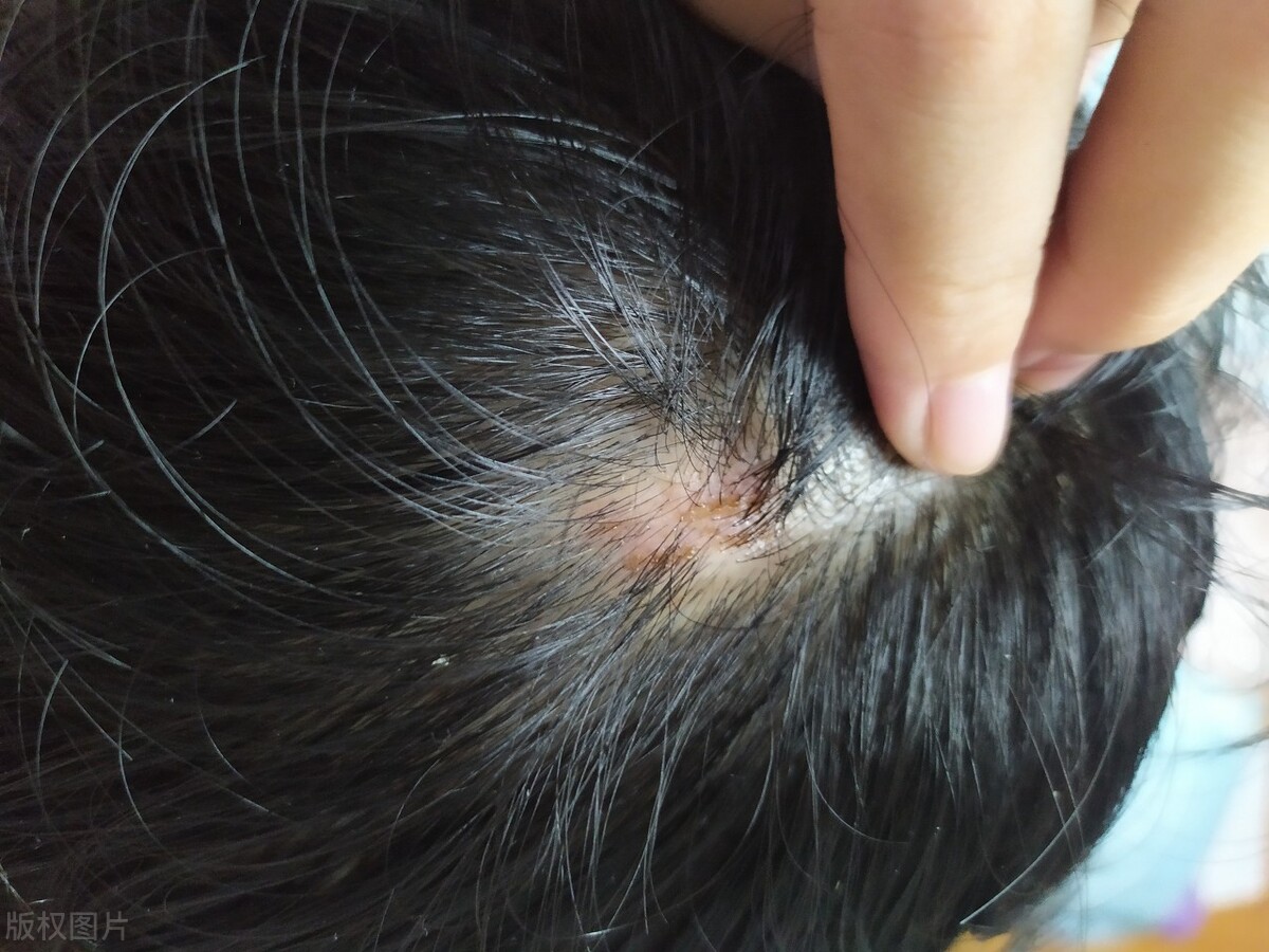 是什么导致毛发旺盛的,为什么身上的毛发比较旺盛