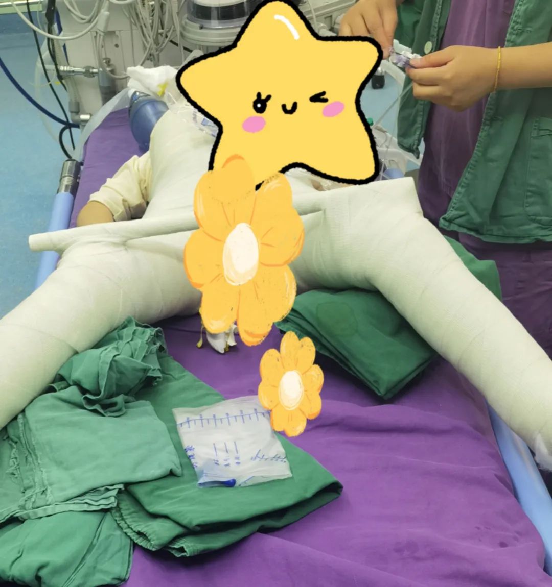 弹性髓内钉治疗儿童骨折,成骨不全可延长髓内钉