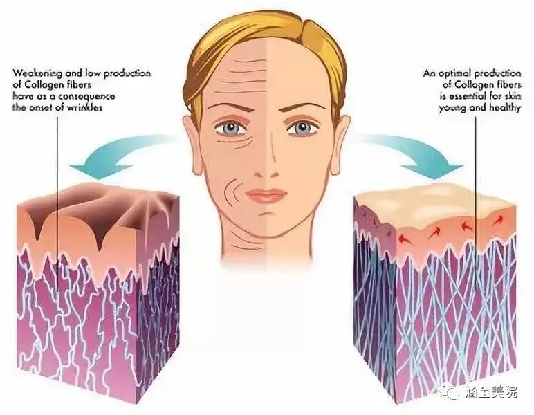 热玛吉能改善颈部皱纹吗,热玛吉颈部除皱效果