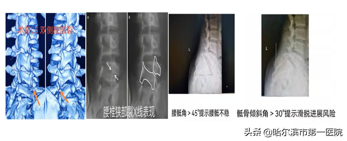 反复腰腿痛，去神经外科查查——哈市第一院神经外科成功完成首例腰椎峡部裂伴腰骶椎不稳术