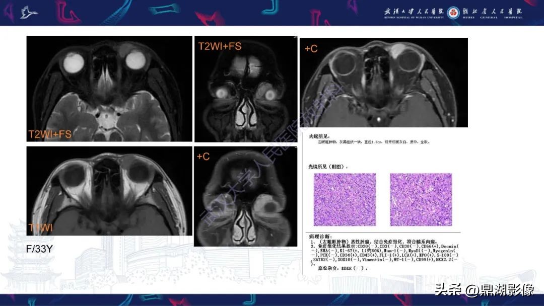 阴道肉瘤症状,阴道肉瘤的早期症状