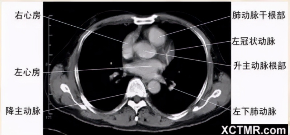 胸腹部盆腔ct主要检查什么,女性盆腔ct断层解剖结构图