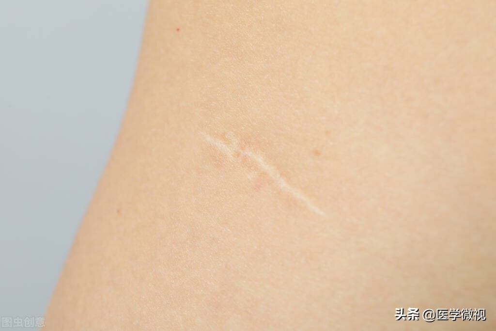 瘢痕是指伤口愈合后留下的疤痕,瘢痕和手术疤痕有什么区别