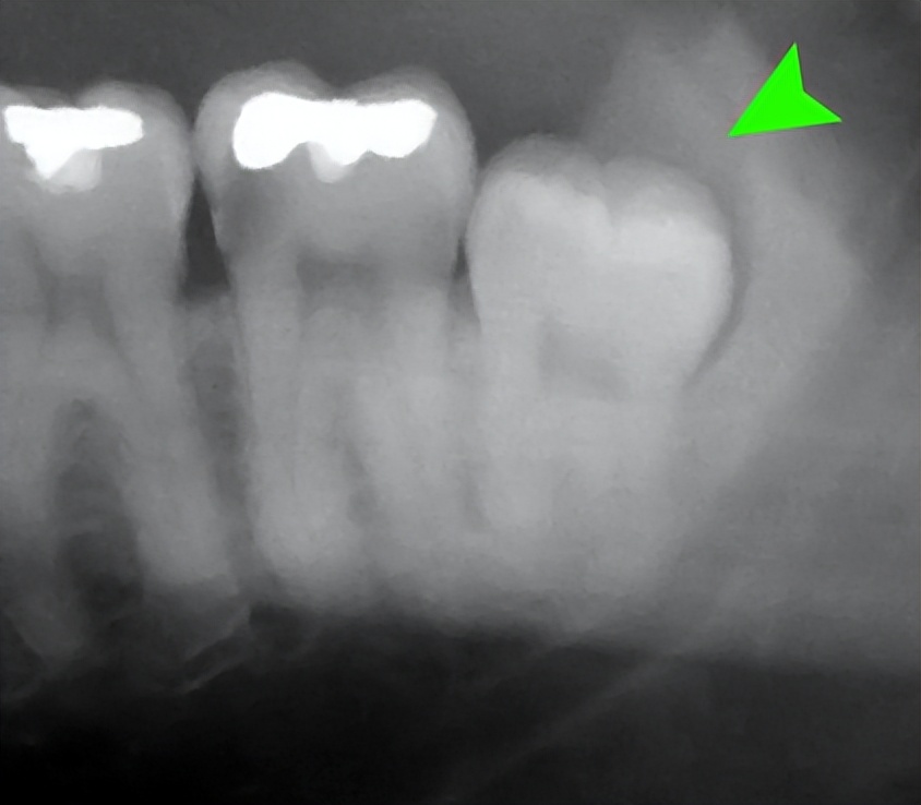 分享一些人类还在演化的好消息，比如我们正在失去智齿丨说点人事