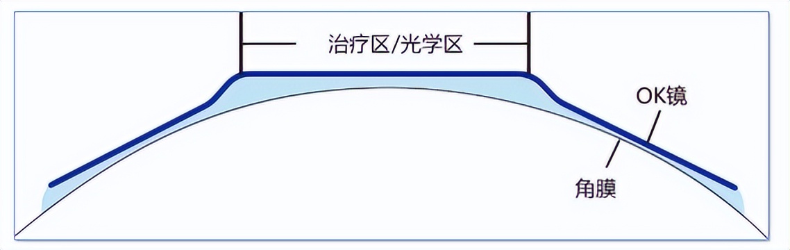 「专家解答」佩戴ok镜后孩子为什么感觉叠影和眩光？