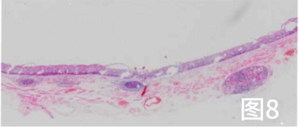病例档案纪录片,食管早期癌的内镜筛查