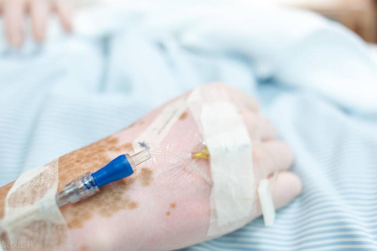 局限性白癜风一般发生在什么部位,什么是阶段性的局限性的白癜风