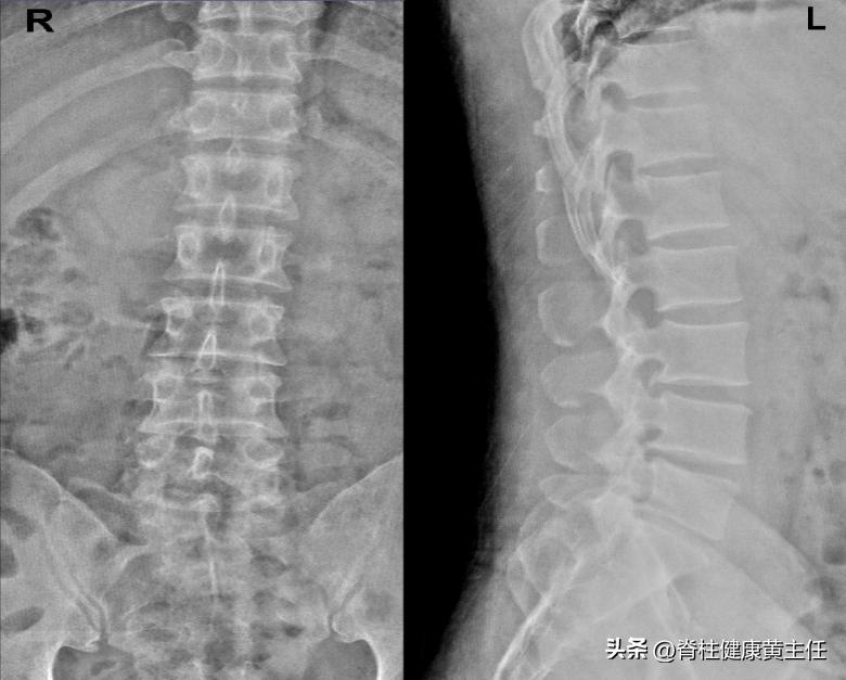 腰间盘突出压迫腿疼怎么治疗,腰间盘突出坐骨神经痛左臀酸痛