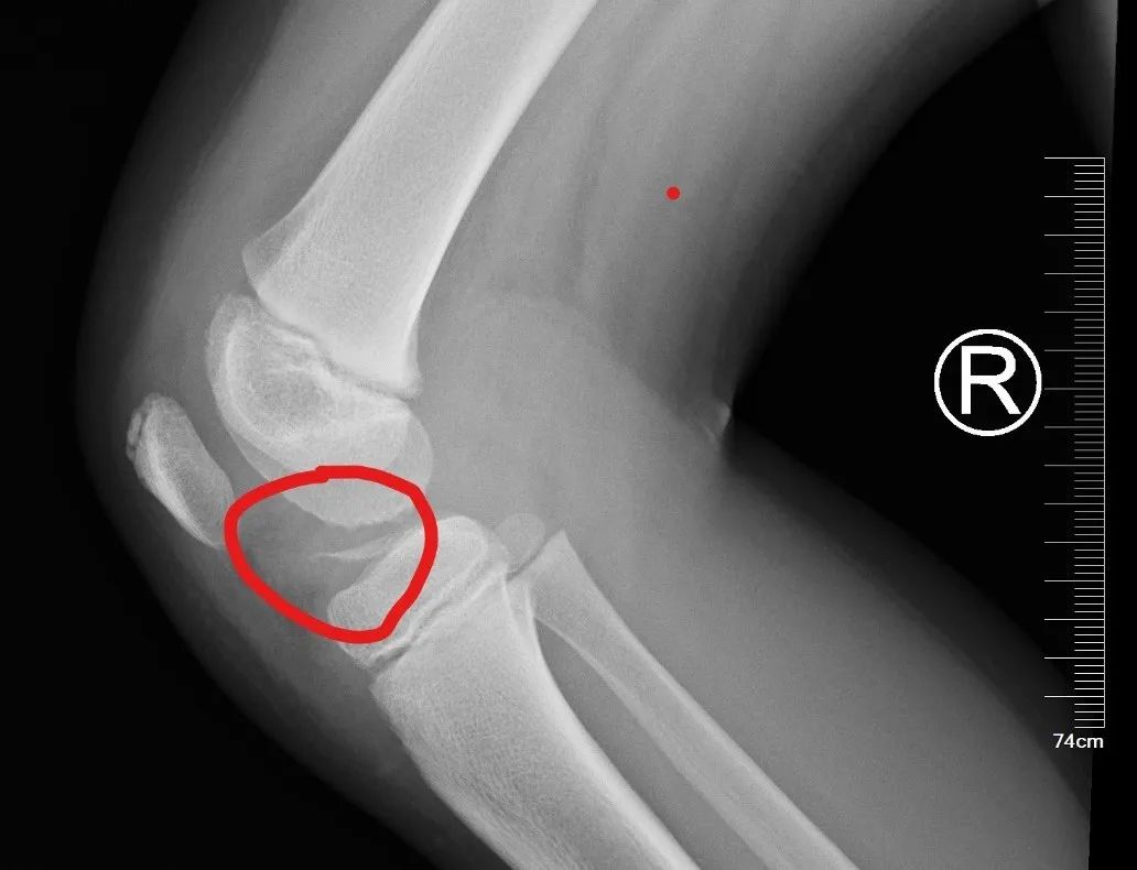 六岁女孩膝盖磕了软组织肿胀,髌骨骨折膝关节肿胀