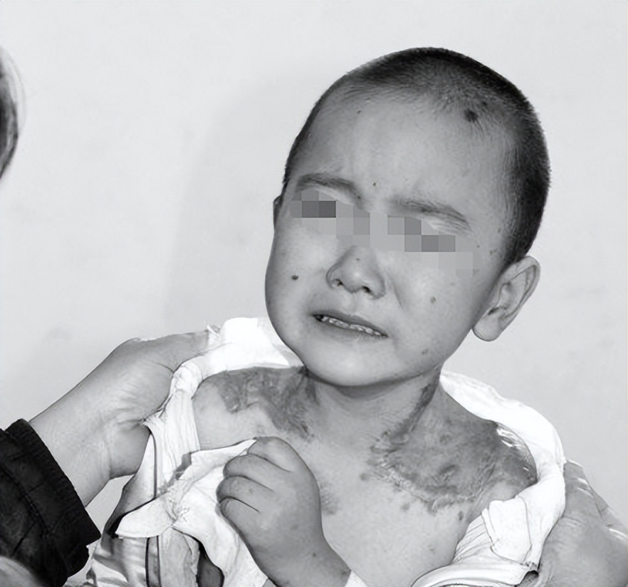 2010年河北行唐，儿子患病身长“巨型黑痣”，母亲为救子割皮移植