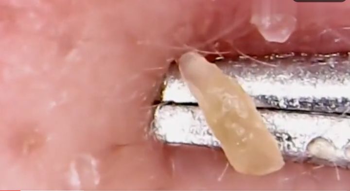 鼻子外面挤出来的白色东西臭臭的,从鼻子上挤出的白色状东西是什么