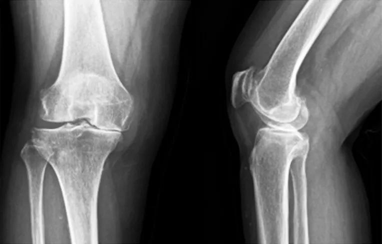 活动与固定平台单髁假体对膝关节前内侧骨关节炎的疗效比较