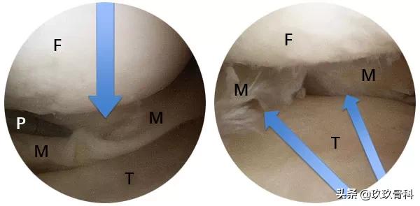 半月板损伤是否需要手术,外侧半月板损伤手术费用
