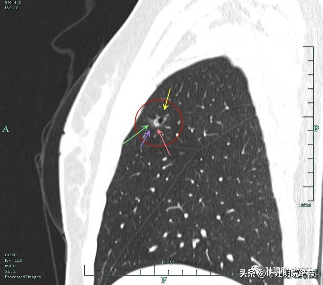 磨玻璃结节伴有增生是癌症吗,磨玻璃结节会是别的癌转移的吗