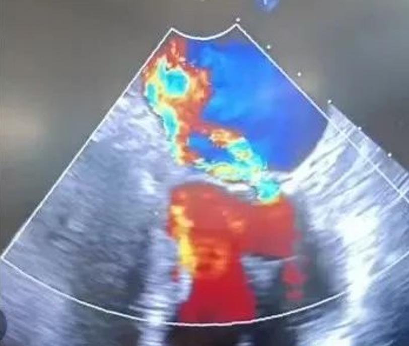 mitraclip手术10年存活,mitraclip术后效果
