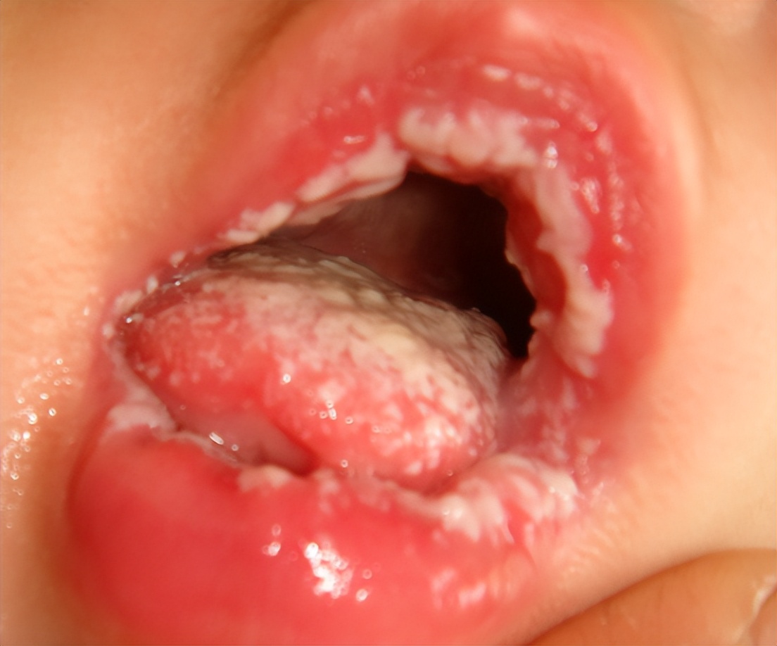 宝宝口腔有小白点是什么原因,五个月宝宝口腔上颚有白块图片