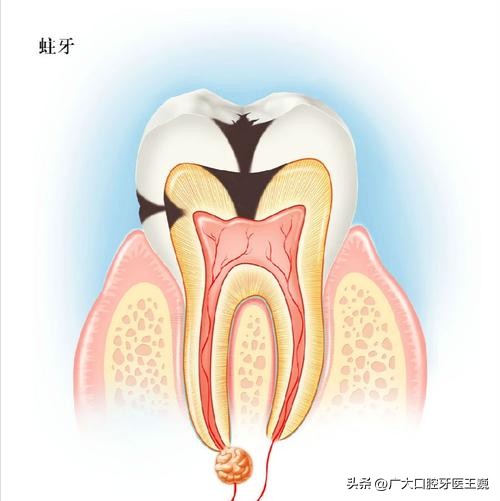 儿童蛀牙牙痛补牙还是根管治疗好,蛀牙烂空了是种植好还是治疗好