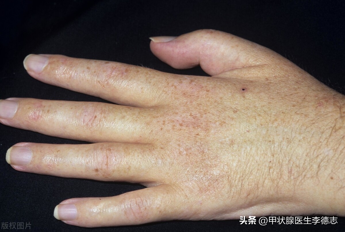 甲亢用赛治后体重增加怎么办,甲亢吃药后体重增加正常吗