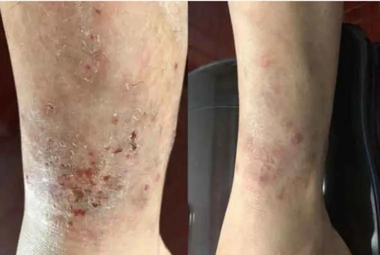 倪海厦说小孩湿疹,为什么说湿疹是大病前兆