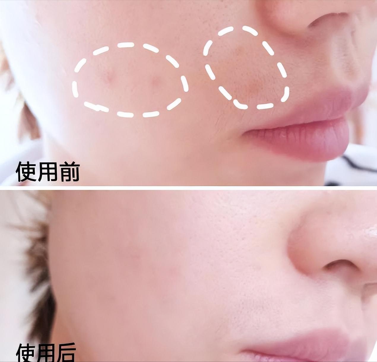 泰国女子打6年美白针六胜肽,女子打美白针后身患多病